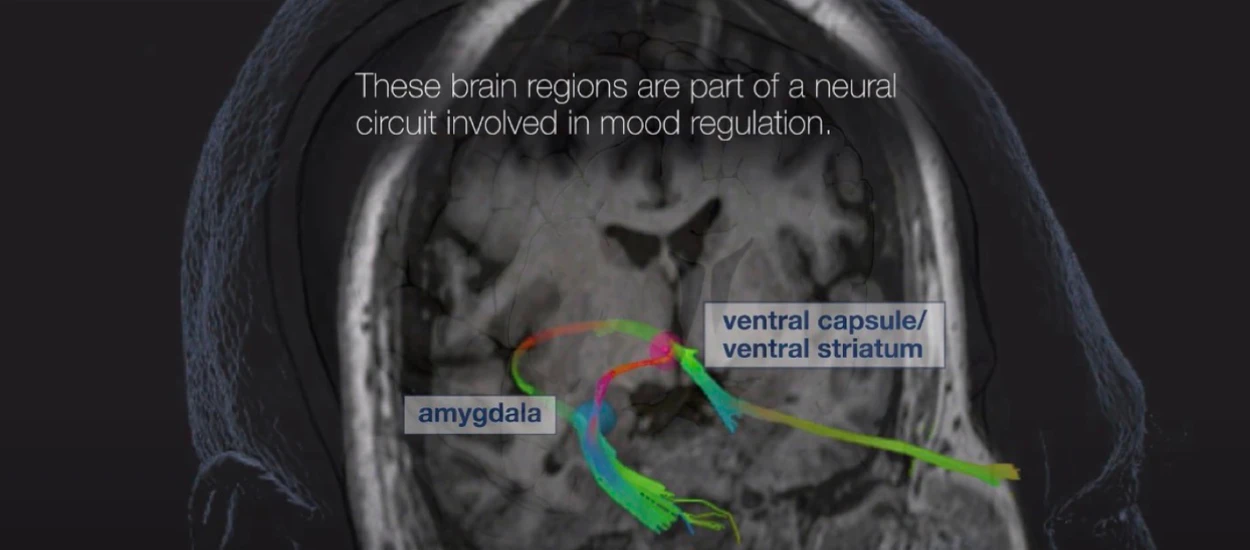 „Personalizowane” implanty mózgu szansą dla chorych na depresje